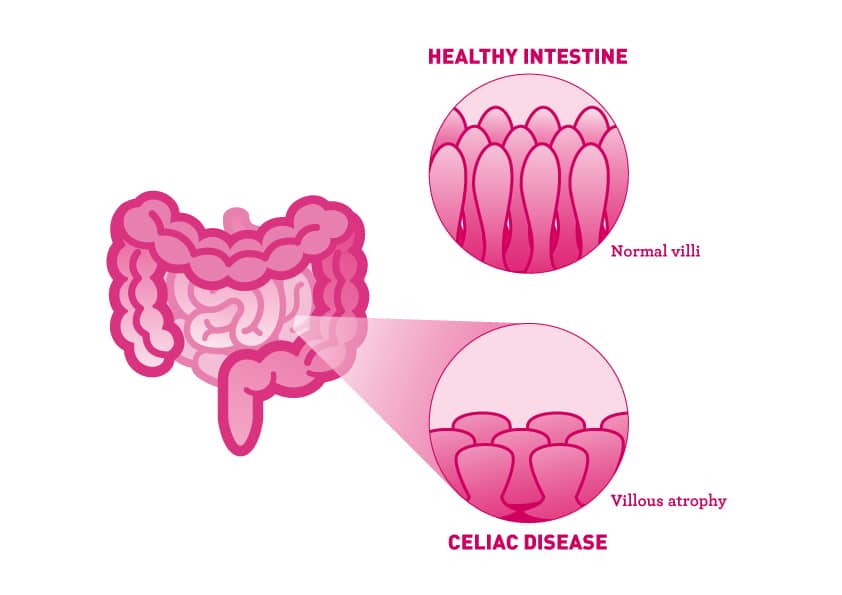 Illustrating the Normal Villi in a healthy small intestine vs. the villous atrophy and shortened villi from Celiac Disease - Infographic - Amy Myers MD®