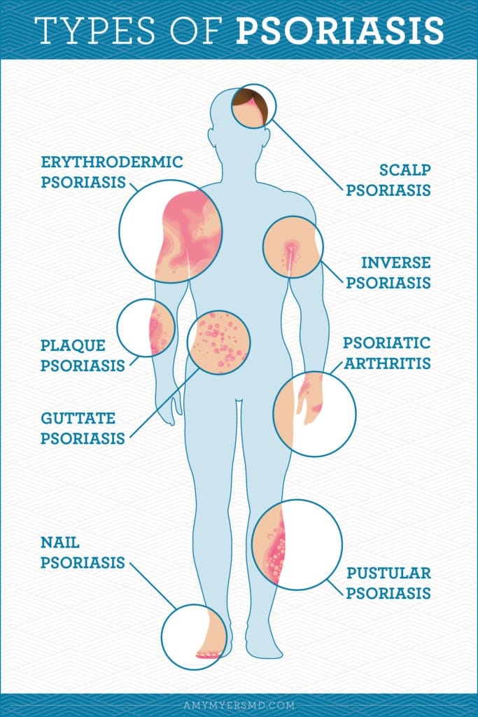 Types Of Psoriasis - Infographic - Amy Myers MD®