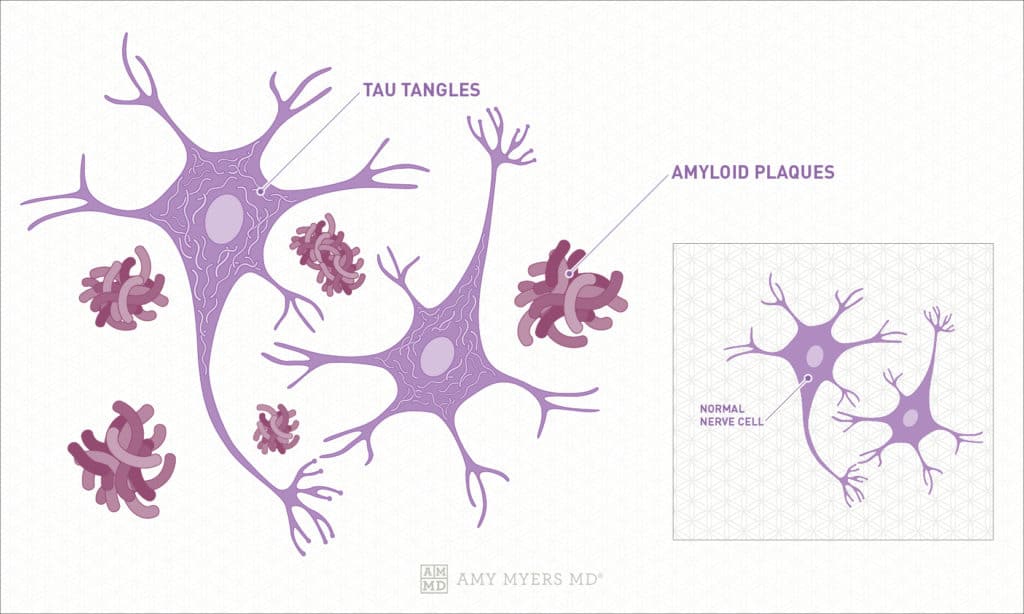 What Is Alzheimer's? Tau Tangles, Amyloid Plaques - Infographics - Amy Myers MD®