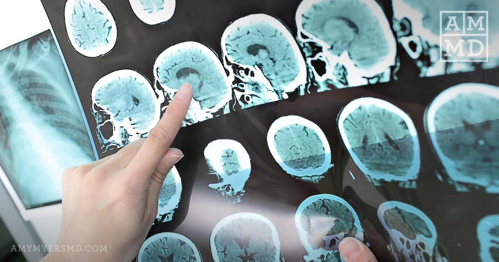 Clinically Isolated Syndrome An Early Sign of MS Amy Myers MD